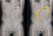 La Aduana detuvo a una mula que intentó viajar a Europa con 84 cápsulas de cocaína en su cuerpo